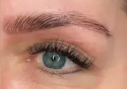 Brow Lifting nachher Beispiel 1