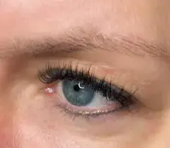 Brow Lifting vorher Beispiel 1